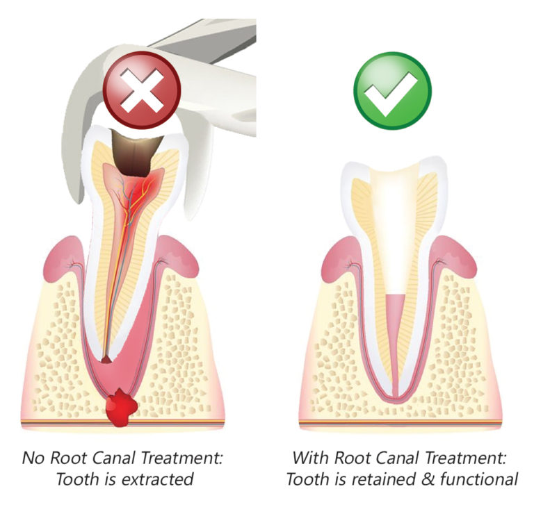 Save Your Tooth With Root Canal Treatment DT Smile Care