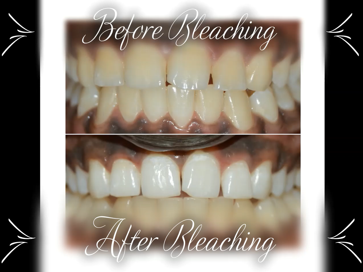 Dental Bleaching Pros And Cons Which One To Choose Dt Smile Care